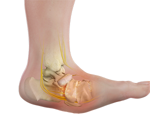 Charcot Reconstruction