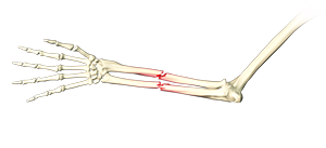 Adult Forearm Fractures