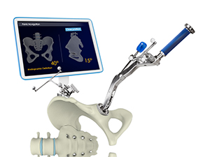 Computer Navigated Total Hip Replacement