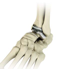 Ankle Joint Replacement