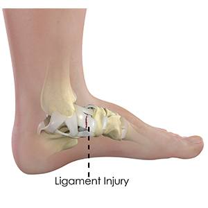 Ankle Ligament Injury