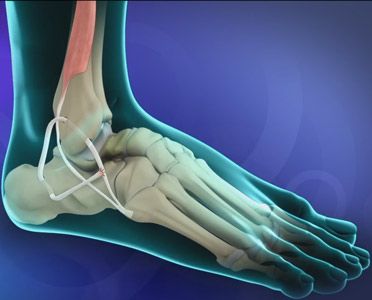 Ankle ligament Reconstruction