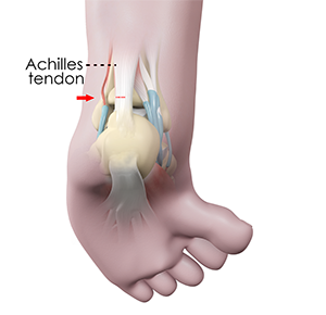 Ankle Tenotomy