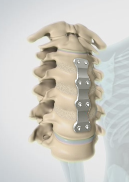 Cervical Corpectomy