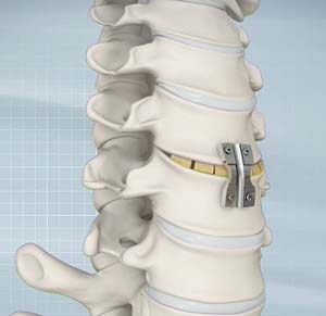 Anterior Cervical Discectomy with Fusion