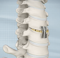 Anterior Cervical Discectomy