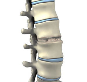 Anterior Lumbar Interbody Fusion (ALIF)