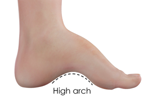 Cavus Foot Deformity