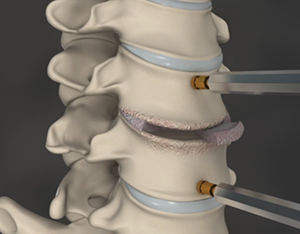 Cervical Discetomy