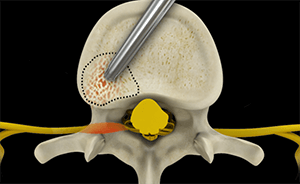 Cervical Foraminotomy