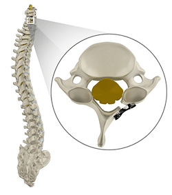 Cervical Laminoplasty