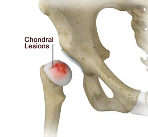 Chondral Injuries