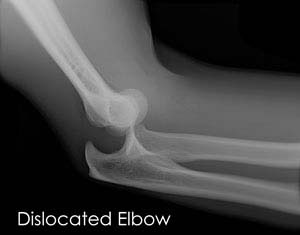 Elbow Dislocations