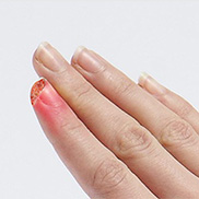 Fingertip Injuries