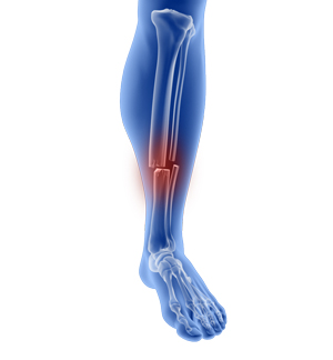 Leg Fractures