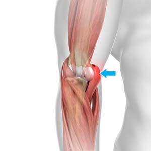 Golfer's Elbow