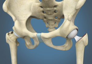 Hip Hemiarthroplasty 