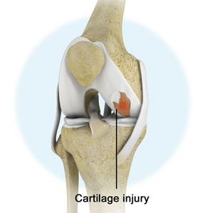 Knee Cartilage Restoration