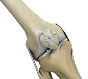 Knee Fracture Surgery River Forest | Knee Fracture Treatment Elmhurst