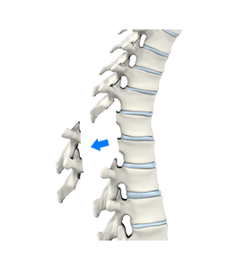 Cervical Laminectomy