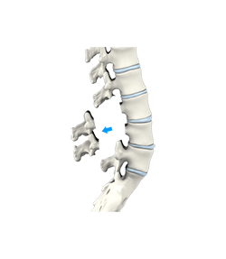 Lumbar Laminectomy