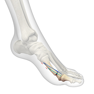 Minimally Invasive Bunion Surgery