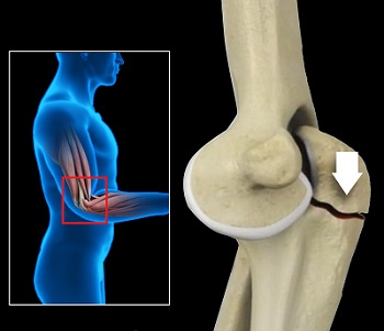 Olecranon Fracture