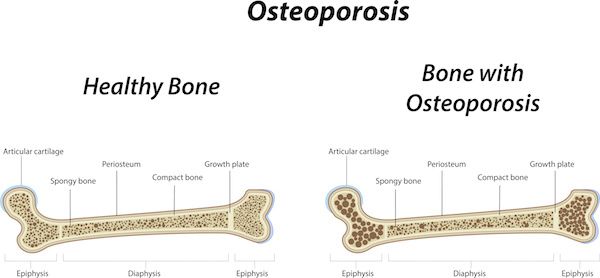 Osteoporosis