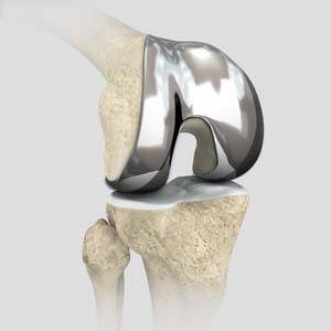 Outpatient Total Knee Replacement