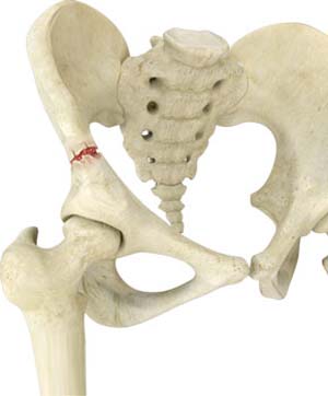 Pelvic Fractures