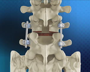 Posterolateral Lumbar Fusion