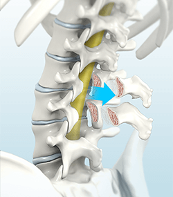 Posterior Lumbar Interbody Fusion (PLIF)