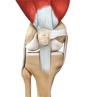 Quadriceps Tendon Repair