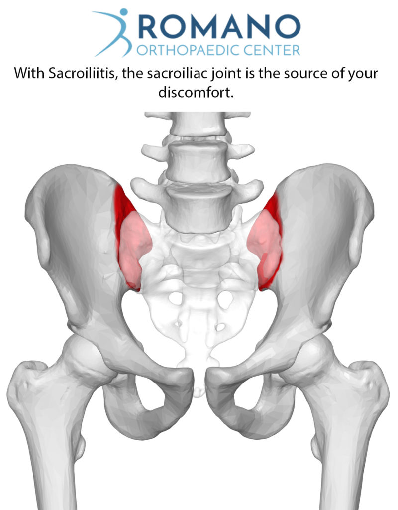 Sacroiliitis