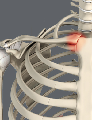 SC Joint Injury Reconstruction