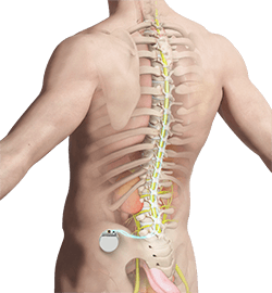 Spinal Cord Stimulator Placement
