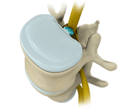 Spinal Decompression