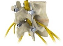 Spinal Fusion