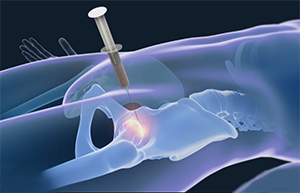 Stem Cell Therapy for Hip Injuries