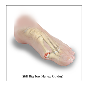 Hallux Rigidus—Common Causes, Symptoms & Treatment - Custom