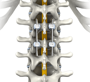 Thoracic Spinal Fusion