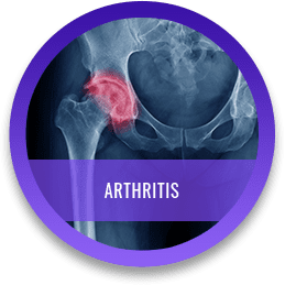 Arthritis